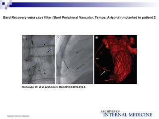 Copyright restrictions may apply.
Nicholson, W. et al. Arch Intern Med 2010;0:2010.316-5.
Bard Recovery vena cava filter (Bard Peripheral Vascular, Tempe, Arizona) implanted in patient 2
 