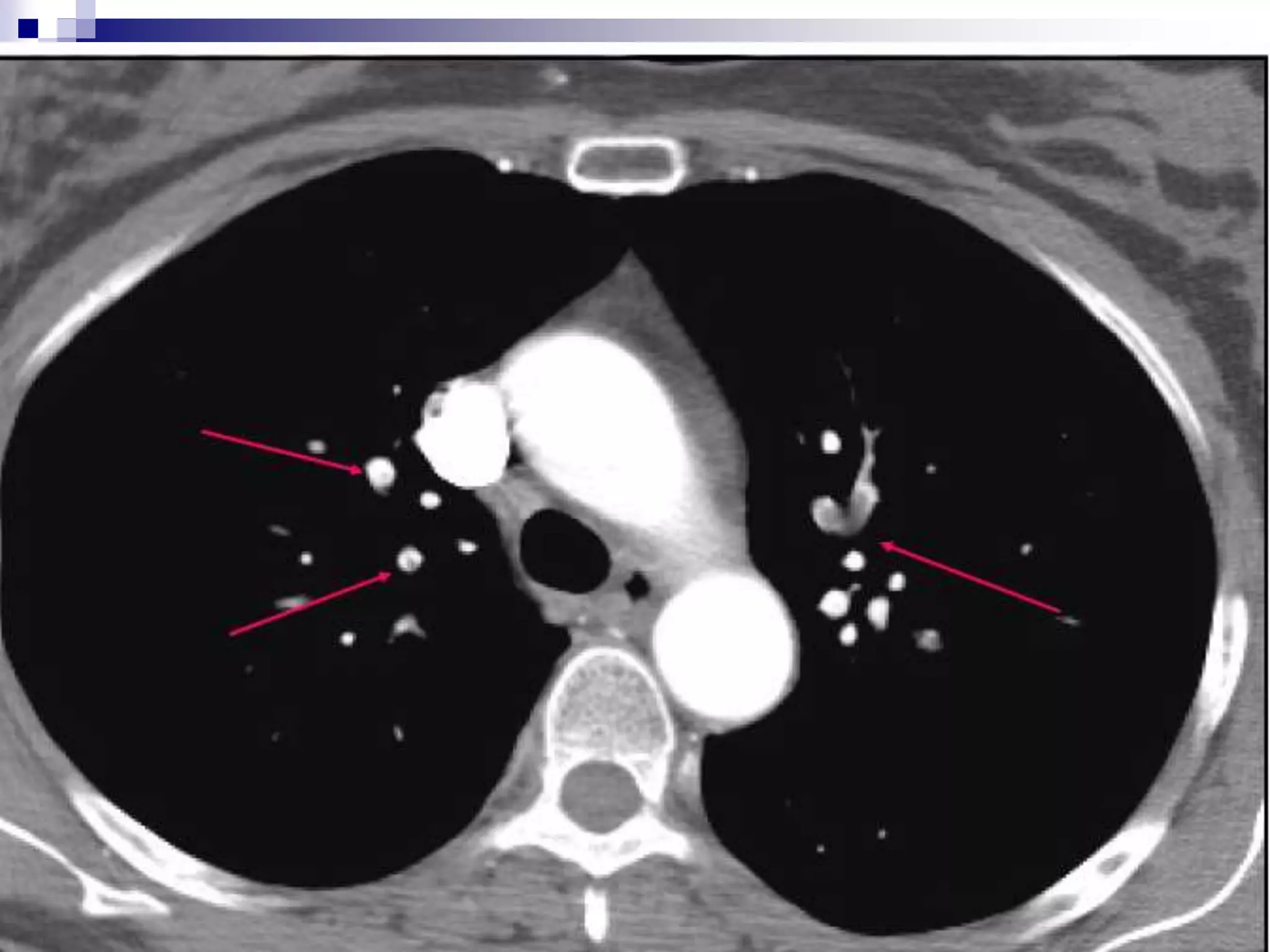 Acute Pulmonary Embolism Overview lecture.ppt
