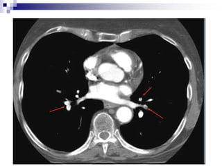 Acute Pulmonary Embolism Overview lecture.ppt
