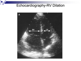 Echocardiograms before and after Thrombolysis
Echocardiography-RV Dilation
 