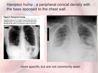 Hampton hump : a peripheral conical density with
the base apposed to the chest wall
more specific but are not commonly seen
 