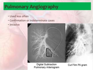 • Used less often
• Confirmation or indeterminate cases
• Invasive
Pulmonary Angiography
 