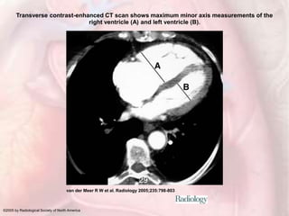 Transverse contrast-enhanced CT scan shows maximum minor axis measurements of the
right ventricle (A) and left ventricle (B).
van der Meer R W et al. Radiology 2005;235:798-803
©2005 by Radiological Society of North America
 