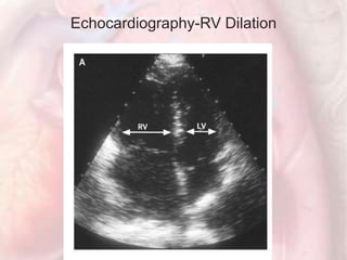 Echocardiograms before and after Thrombolysis
Echocardiography-RV Dilation
 