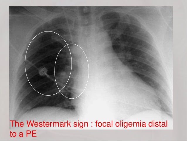 Acute Pulmonary Embolism