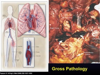 Gross Pathology
Tapson V. N Engl J Med 2008;358:1037-1052
 
