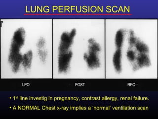 LUNG PERFUSION SCAN




• 1st line investig in pregnancy, contrast allergy, renal failure.
• A NORMAL Chest x-ray implies a ‘normal’ ventilation scan
 
