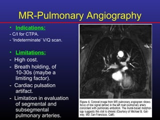 MR-Pulmonary Angiography
• Indications:
- C/I for CTPA.
- ‘Indeterminate’ V/Q scan.

• Limitations:
- High cost.
- Breath holding, of
  10-30s (maybe a
  limiting factor).
- Cardiac pulsation
  artifact.
- Limitation in evaluation
  of segmental and
  subsegmental
  pulmonary arteries.
 