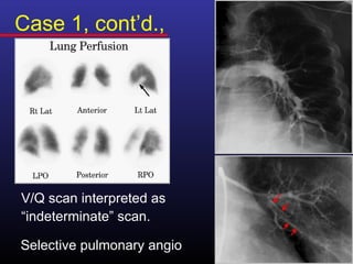 Case 1, cont’d.,




V/Q scan interpreted as
“indeterminate” scan.

Selective pulmonary angio
 