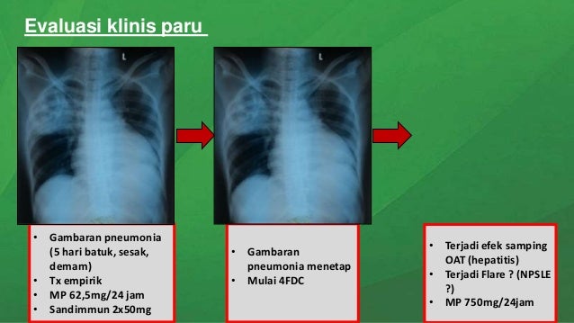 Acute pulmonary tuberculosis in sle