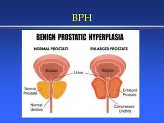 BPH
 