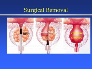 Surgical Removal
 