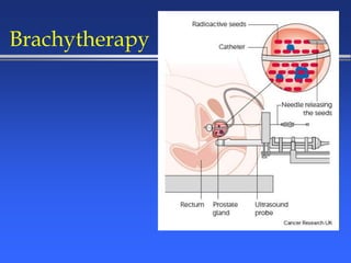 Brachytherapy
 