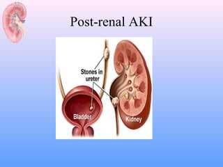 Post-renal AKI
 