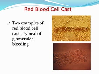 Red Blood Cell Cast
• Two examples of
red blood cell
casts, typical of
glomerular
bleeding.
 