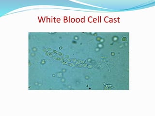 White Blood Cell Cast
 