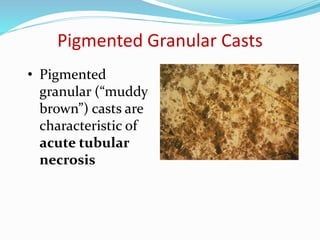 Pigmented Granular Casts
• Pigmented
granular (“muddy
brown”) casts are
characteristic of
acute tubular
necrosis
 