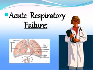 Acute Respiratory
Failure:
 