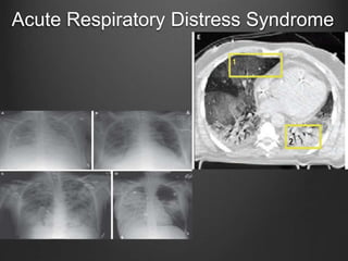 Acute Respiratory Distress Syndrome
 