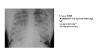 Acute respiratory distress syndrome | PPTX