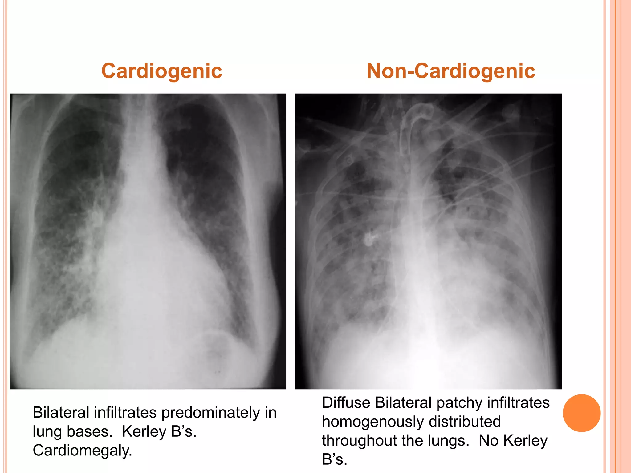 Cardiogenic                           Non-Cardiogenic




                                         Diffuse Bilateral patchy infiltrates
Bilateral infiltrates predominately in
                                         homogenously distributed
lung bases. Kerley B’s.
                                         throughout the lungs. No Kerley
Cardiomegaly.
                                         B’s.
 