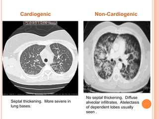 Acute respiratory distress syndrome (ards) | PPTX