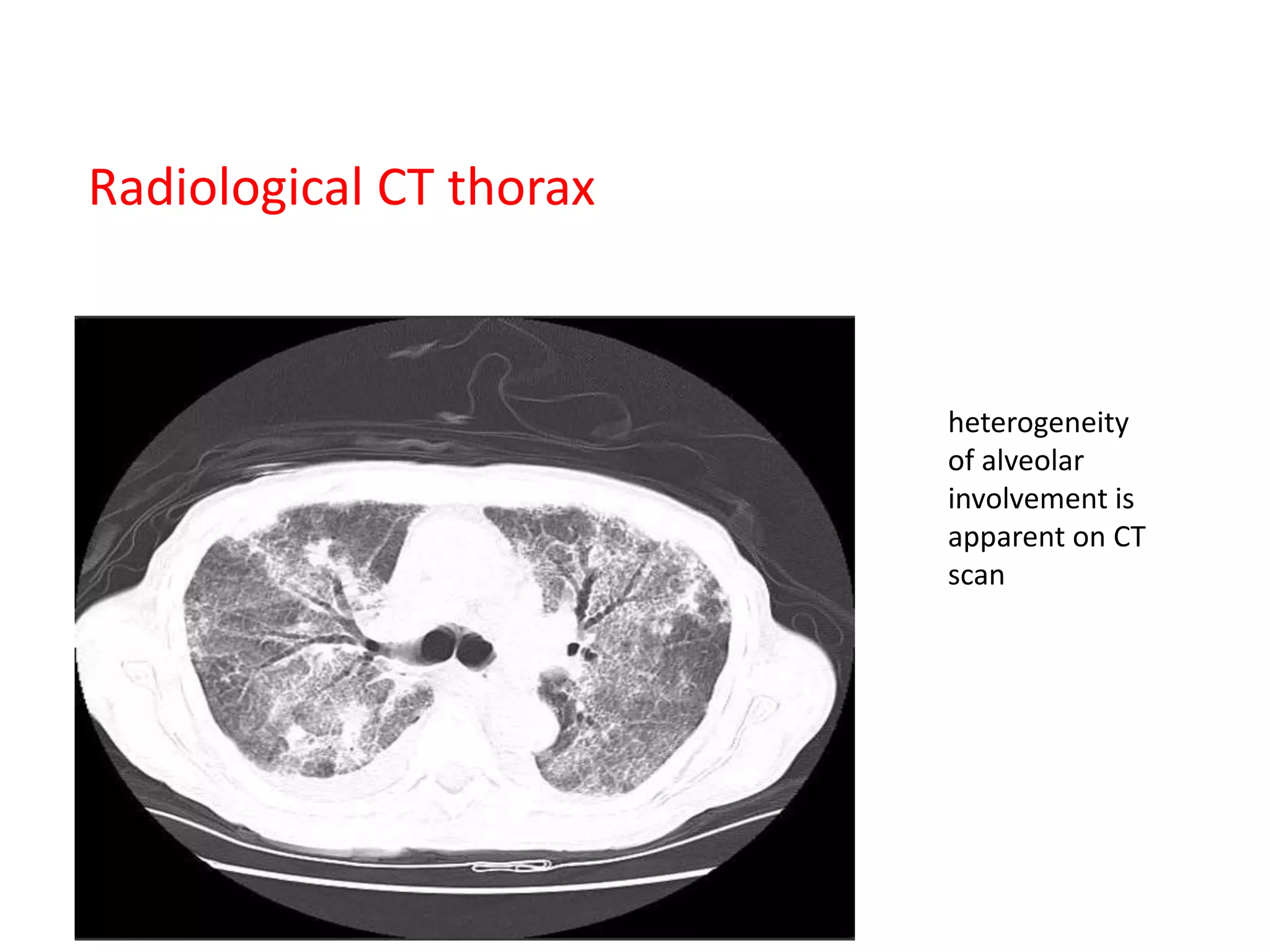 Acute Respiratory Distress Syndrome ARDS | PPTX