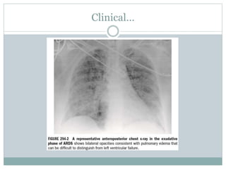Acute respiratory distress syndrome(ARDS) | PPTX