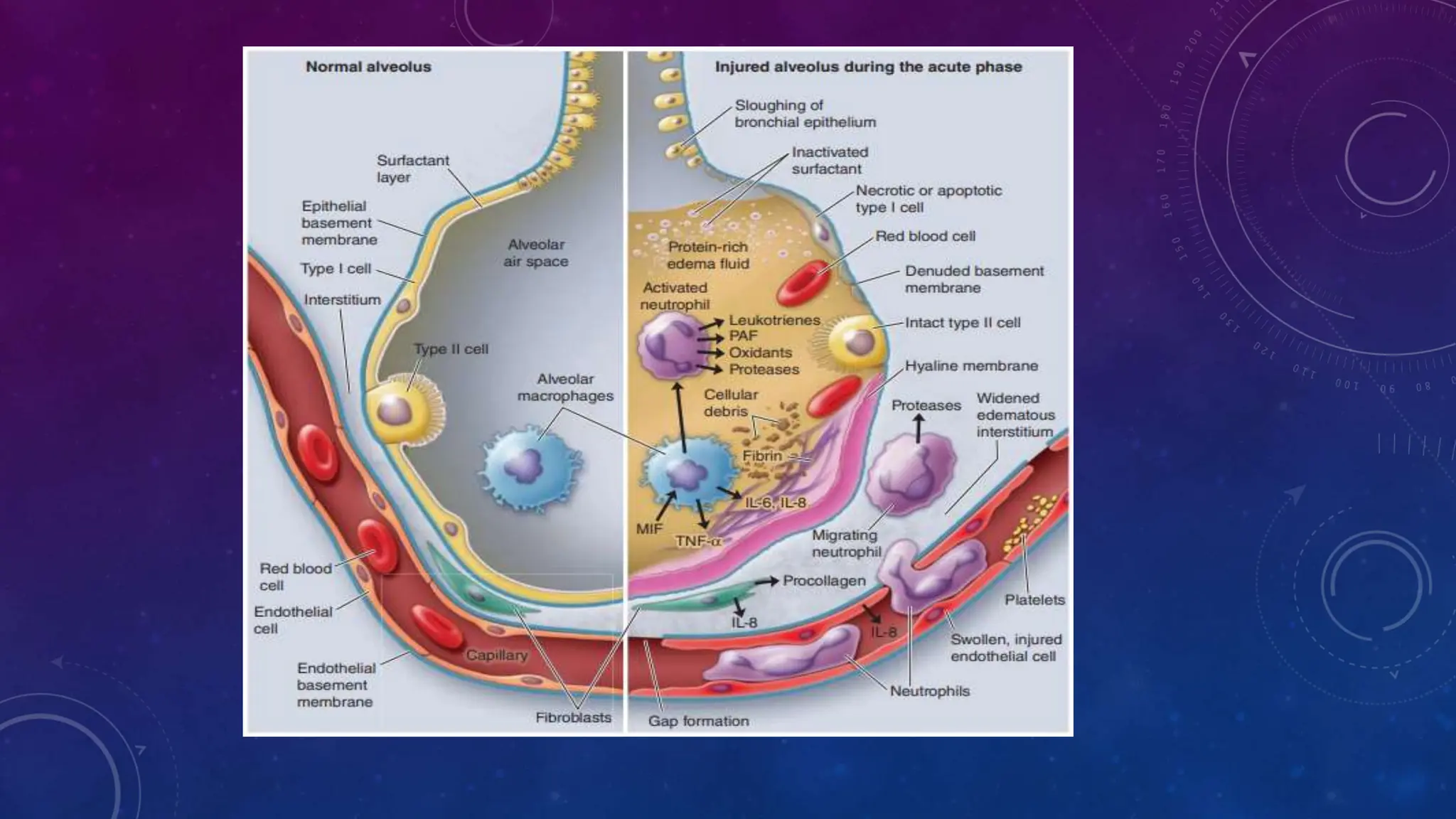 Acute respiratory distress syndrome (ARDS).pptx
