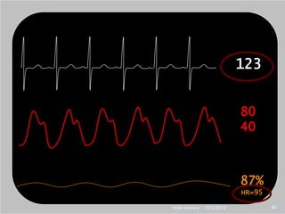 123


                          80
                          40



                          87%
                          HR=95

Ihab Tarawa   10/2/2012           49
 