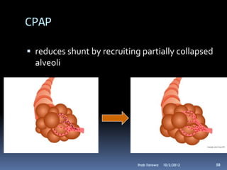 CPAP

 reduces shunt by recruiting partially collapsed
  alveoli




                             Ihab Tarawa   10/2/2012   58
 