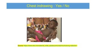Chest indrawing : Yes / No
Source: https://www.who.int/maternal_child_adolescent/child/imci/training-video/en/
 