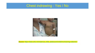 Chest indrawing : Yes / No
Source: https://www.who.int/maternal_child_adolescent/child/imci/training-video/en/
 