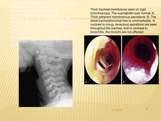 Trachea Dysfunction Acute respiratory tract infections ho (2) | PPTX