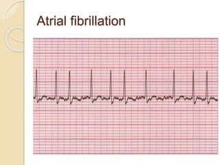 Atrial fibrillation
 