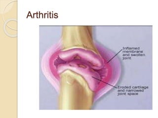 Arthritis
 