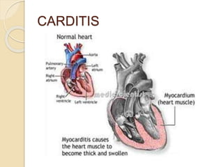 CARDITIS
 
