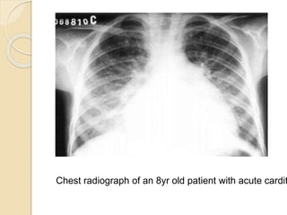 Chest radiograph of an 8yr old patient with acute cardit
 