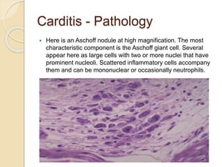 Carditis - Pathology
 Here is an Aschoff nodule at high magnification. The most
characteristic component is the Aschoff giant cell. Several
appear here as large cells with two or more nuclei that have
prominent nucleoli. Scattered inflammatory cells accompany
them and can be mononuclear or occasionally neutrophils.
 