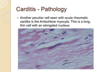 Carditis - Pathology
 Another peculiar cell seen with acute rheumatic
carditis is the Anitschkow myocyte. This is a long,
thin cell with an elongated nucleus.
 