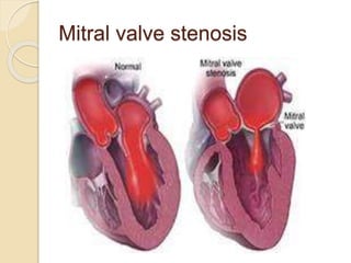 Mitral valve stenosis
 