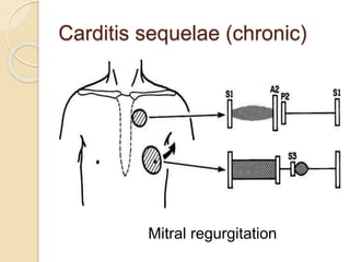 Carditis sequelae (chronic)
Mitral regurgitation
 