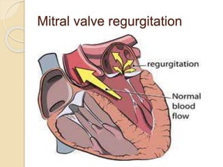 Mitral valve regurgitation
 
