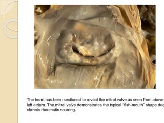 The heart has been sectioned to reveal the mitral valve as seen from above
left atrium. The mitral valve demonstrates the typical “fish-mouth” shape due
chronic rheumatic scarring.
 