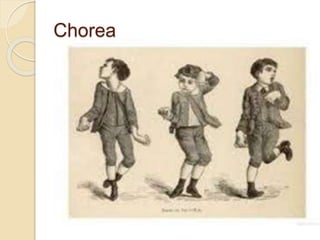Chorea
 