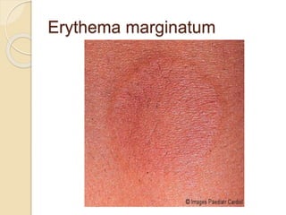 Erythema marginatum
 