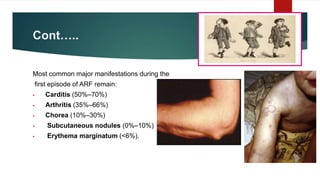 Acute rheumatic fever | PPTX