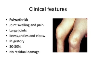 Clinical features
• Polyarthritis
• Joint swelling and pain
• Large joints
• Kness,ankles and elbow
• Migratory
• 30-50%
• No residual damage
 