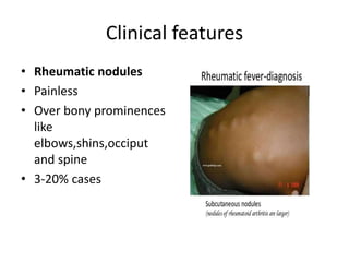 Clinical features
• Rheumatic nodules
• Painless
• Over bony prominences
like
elbows,shins,occiput
and spine
• 3-20% cases
 