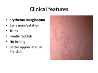 Clinical features
• Erythema marginatum
• Early manifestation
• Trunk
• Faintly reddish
• No itching
• Better appreciated in
fair skin
 